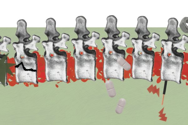Tratamento de Lesão Medular: Eficácia Comprovada, Acesso Limitado